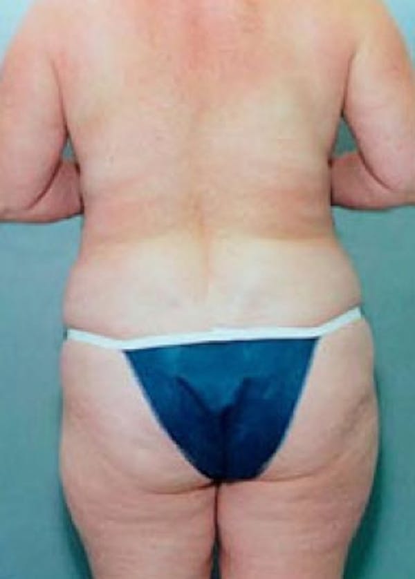 Liposuction and Smartlipo Before & After Gallery - Patient 5883358 - Image 2