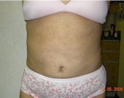 Tummy Tuck Before & After Gallery - Patient 5883359 - Image 2
