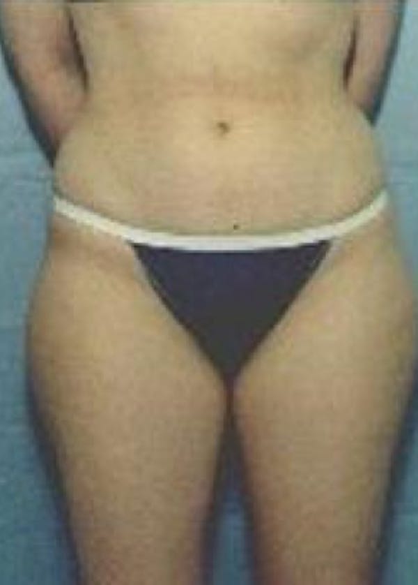 Liposuction and Smartlipo Before & After Gallery - Patient 5883366 - Image 1