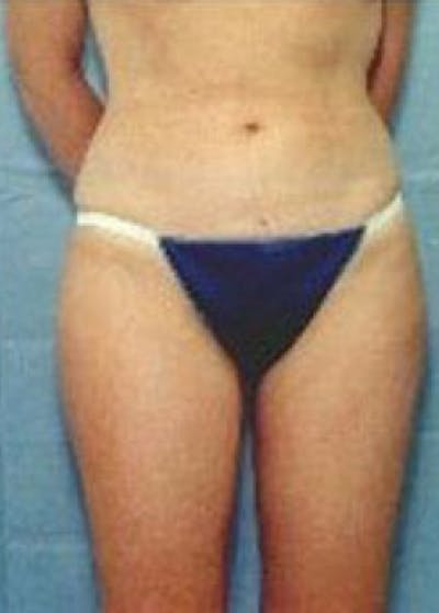 Liposuction and Smartlipo Before & After Gallery - Patient 5883366 - Image 2