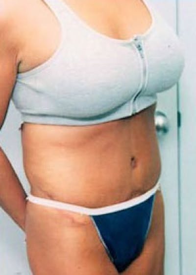 Tummy Tuck Before & After Gallery - Patient 5883367 - Image 2