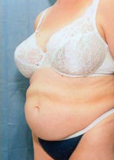 Tummy Tuck Before & After Gallery - Patient 5883369 - Image 1