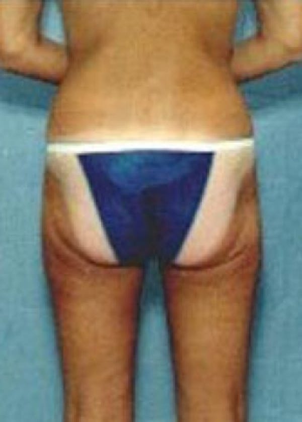 Liposuction and Smartlipo Gallery - Patient 5883368 - Image 2