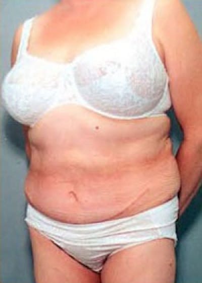 Tummy Tuck Before & After Gallery - Patient 5883369 - Image 2