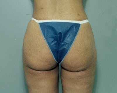 Liposuction and Smartlipo Gallery - Patient 5883370 - Image 2