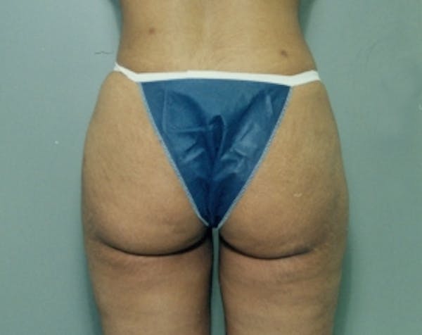 Liposuction and Smartlipo Before & After Gallery - Patient 5883370 - Image 2