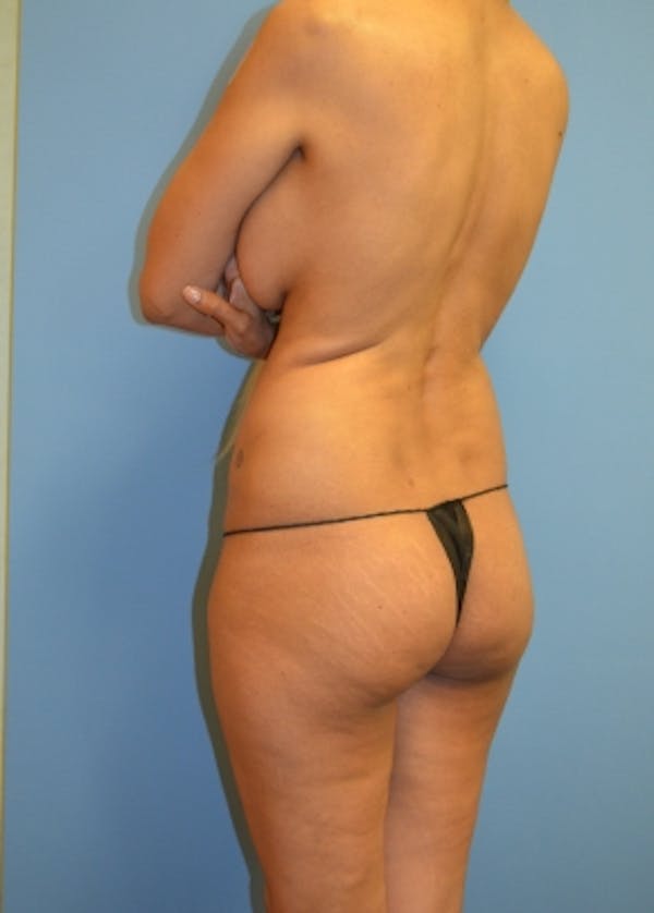 Buttocks Implants Before & After Gallery - Patient 5883373 - Image 1