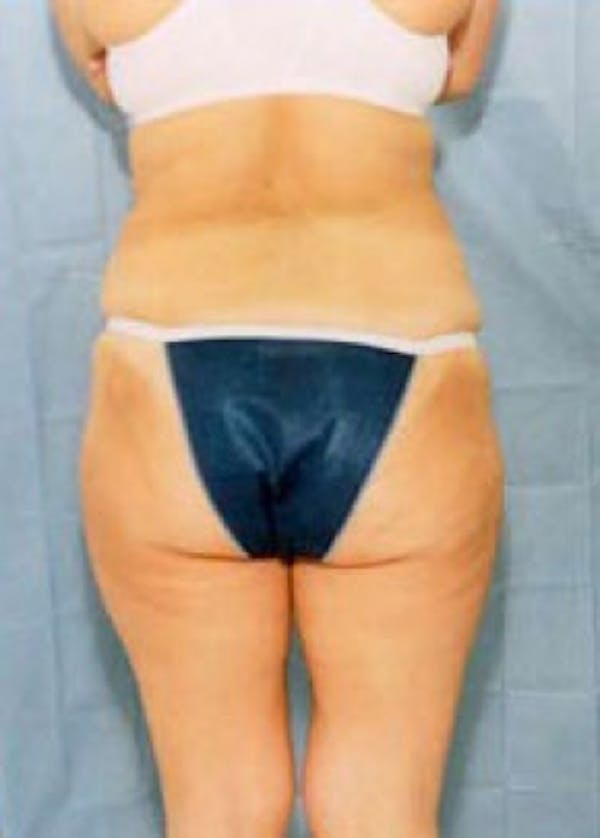 Liposuction and Smartlipo Before & After Gallery - Patient 5883372 - Image 2