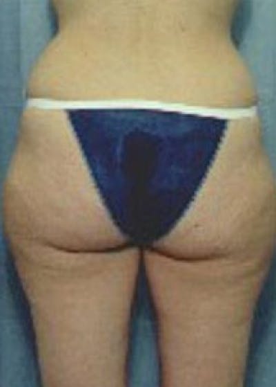 Liposuction and Smartlipo Gallery - Patient 5883375 - Image 1