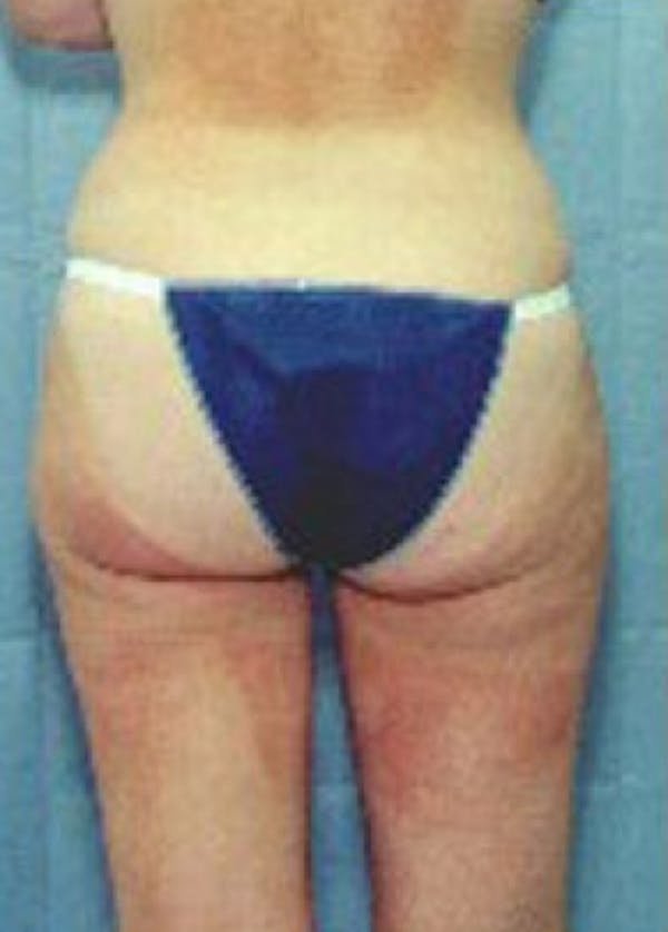 Liposuction and Smartlipo Gallery - Patient 5883375 - Image 2