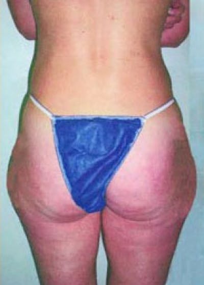 Liposuction and Smartlipo Before & After Gallery - Patient 5883377 - Image 1