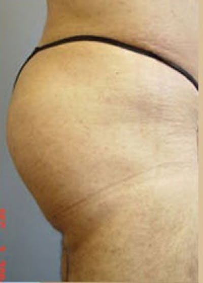Buttocks Implants Before & After Gallery - Patient 5883376 - Image 2