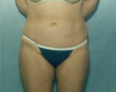 Liposuction and Smartlipo Gallery - Patient 5883379 - Image 2