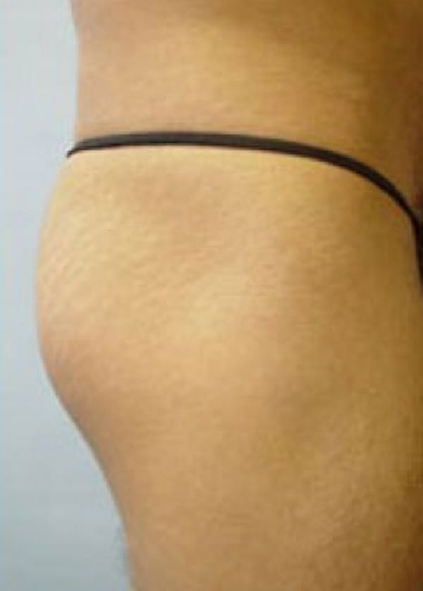Buttocks Implants Before & After Gallery - Patient 5883380 - Image 1