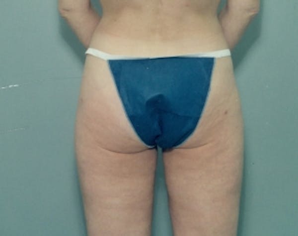 Liposuction and Smartlipo Gallery - Patient 5883384 - Image 2