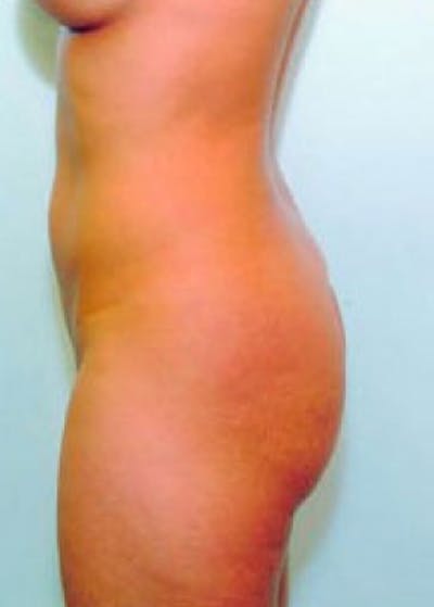 Buttocks Implants Before & After Gallery - Patient 5883385 - Image 1