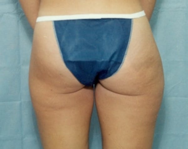 Liposuction and Smartlipo Before & After Gallery - Patient 5883386 - Image 1