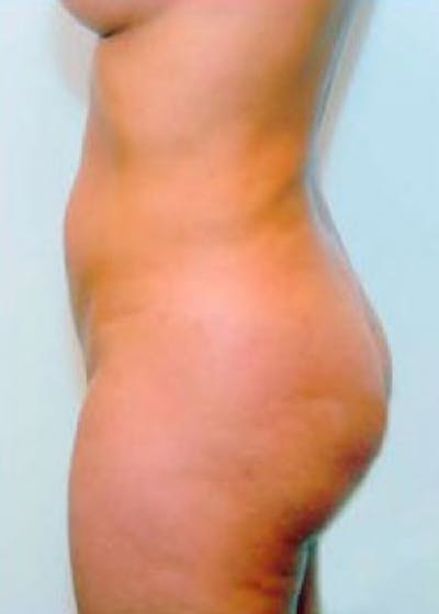Buttocks Implants Before & After Gallery - Patient 5883385 - Image 2
