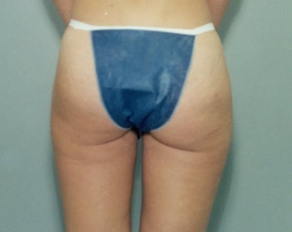 Liposuction and Smartlipo Before & After Gallery - Patient 5883386 - Image 2