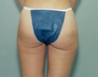 Liposuction and Smartlipo Before & After Gallery - Patient 5883386 - Image 2