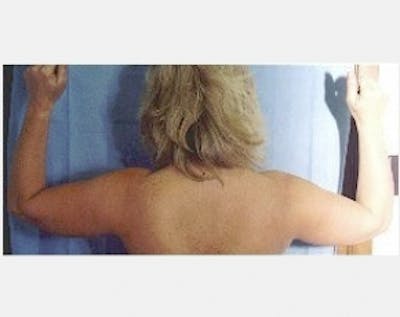 Liposuction and Smartlipo Before & After Gallery - Patient 5883388 - Image 1