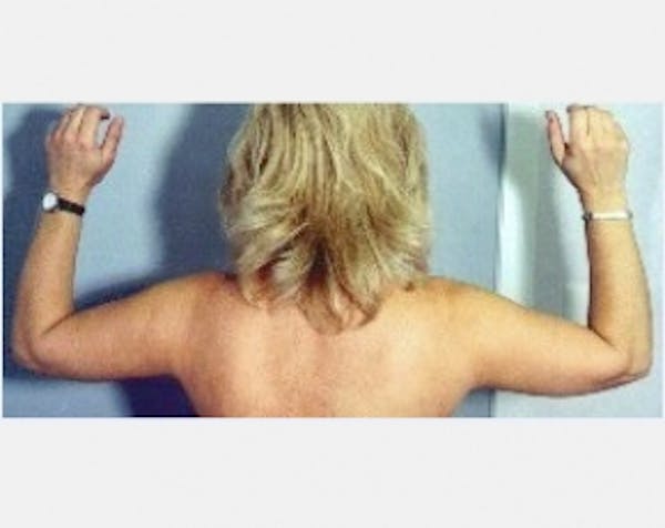 Liposuction and Smartlipo Before & After Gallery - Patient 5883388 - Image 2