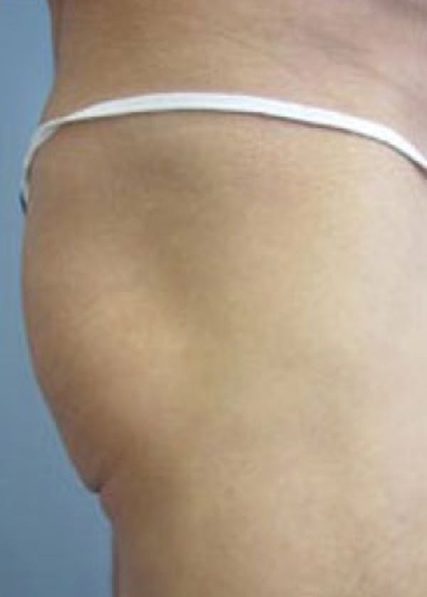 Buttocks Implants Before & After Gallery - Patient 5883394 - Image 1