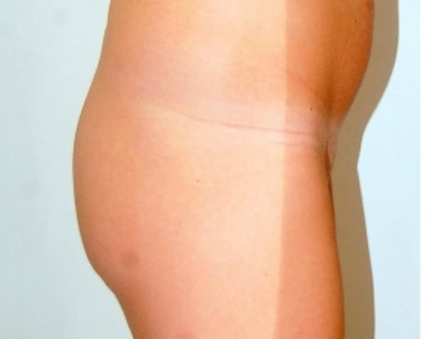 Buttocks Implants Before & After Gallery - Patient 5883395 - Image 1