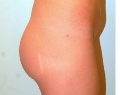 Buttocks Implants Before & After Gallery - Patient 5883395 - Image 2