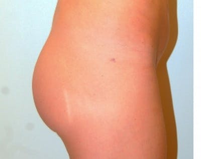 Buttocks Implants Before & After Gallery - Patient 5883395 - Image 2