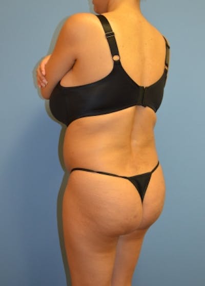 Brazilian Butt Lift Before & After Gallery - Patient 5883402 - Image 1