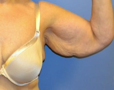 Arm Lift Before & After Gallery - Patient 5883406 - Image 1