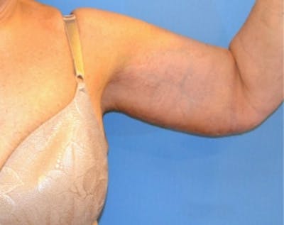 Arm Lift Before & After Gallery - Patient 5883406 - Image 2