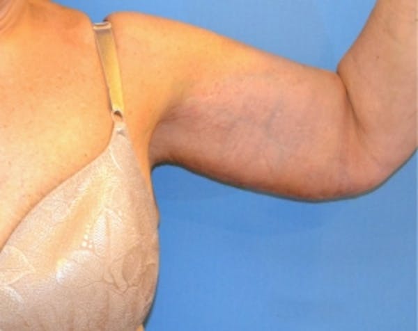 Arm Lift Before & After Gallery - Patient 5883406 - Image 2