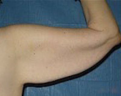 Arm Lift Before & After Gallery - Patient 5883410 - Image 1