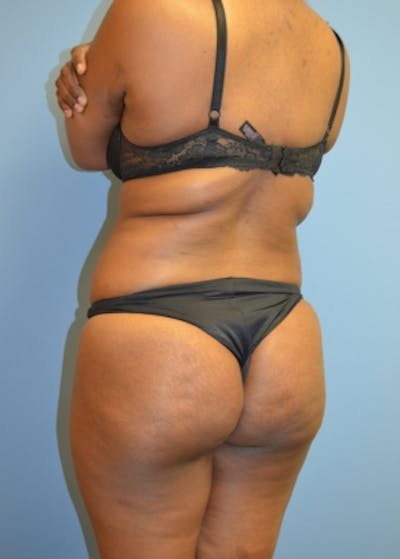 Brazilian Butt Lift Before & After Gallery - Patient 5883411 - Image 1