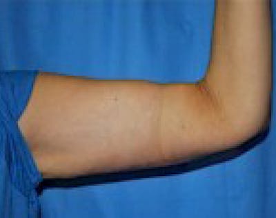 Arm Lift Before & After Gallery - Patient 5883410 - Image 2
