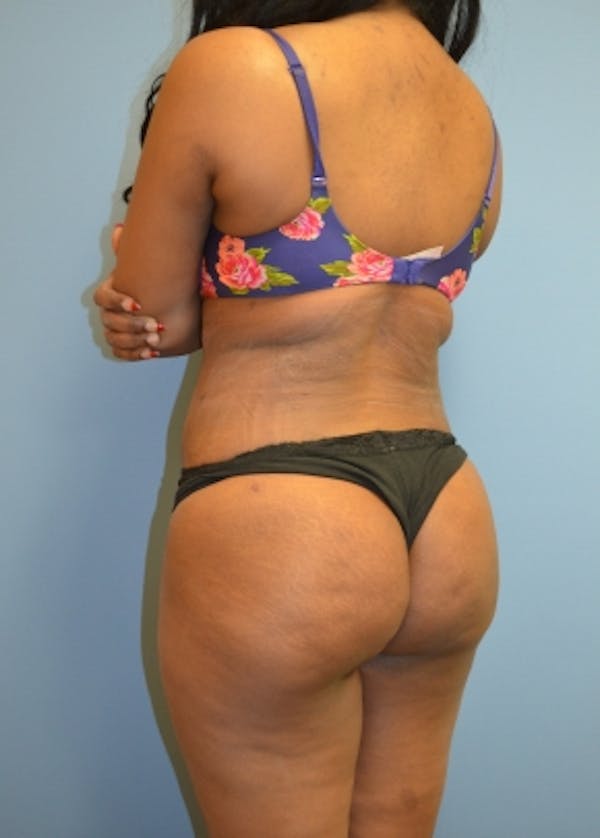 Brazilian Butt Lift Before & After Gallery - Patient 5883411 - Image 2