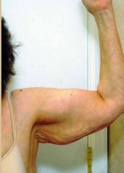 Arm Lift Before & After Gallery - Patient 5883413 - Image 1