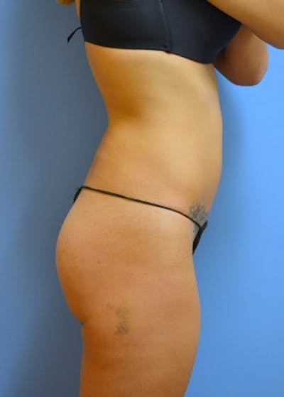 Brazilian Butt Lift Before & After Gallery - Patient 5883414 - Image 1