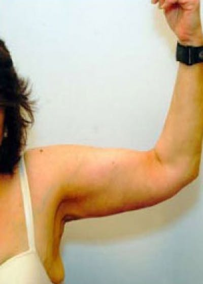 Arm Lift Before & After Gallery - Patient 5883413 - Image 2