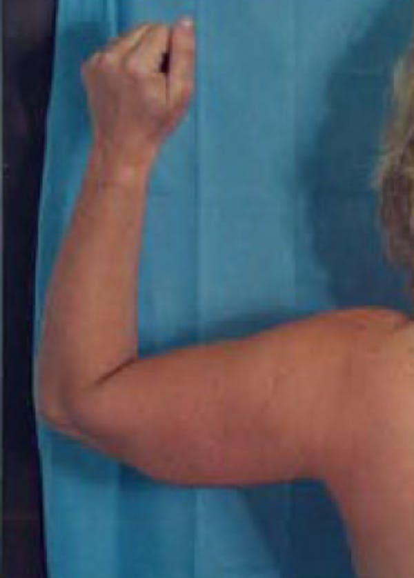 Arm Lift Before & After Gallery - Patient 5883416 - Image 1
