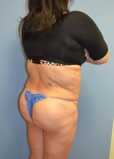 Brazilian Butt Lift Before & After Gallery - Patient 5883417 - Image 2