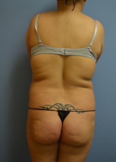 Brazilian Butt Lift Before & After Gallery - Patient 5883419 - Image 1