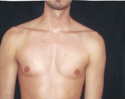 Implants for Bodybuilding Before & After Gallery - Patient 5883426 - Image 1