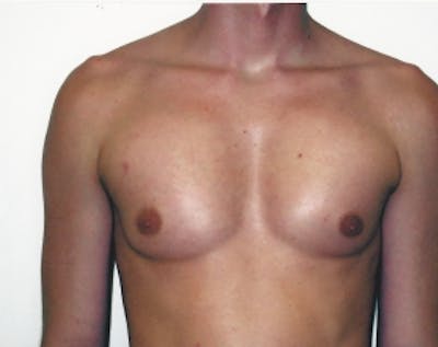 Implants for Bodybuilding Before & After Gallery - Patient 5883426 - Image 2
