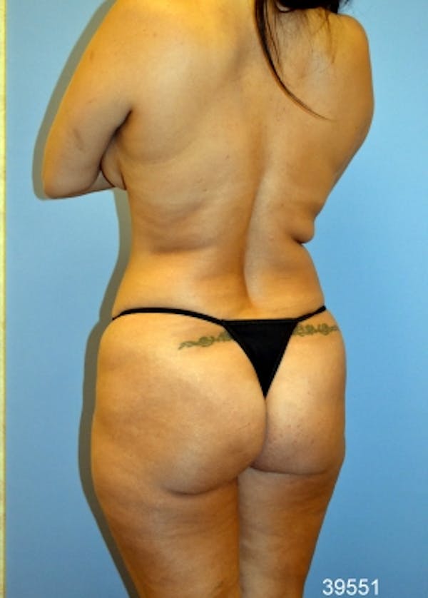Brazilian Butt Lift Before & After Gallery - Patient 5883427 - Image 1