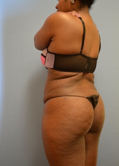 Brazilian Butt Lift Before & After Gallery - Patient 5883430 - Image 2