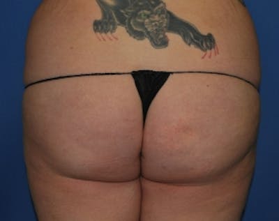 Brazilian Butt Lift Before & After Gallery - Patient 5883437 - Image 1