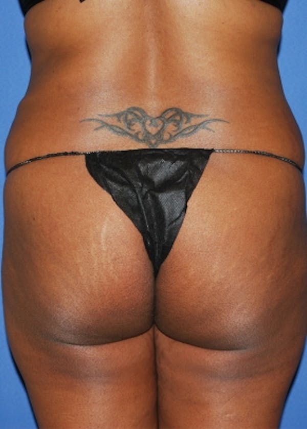 Brazilian Butt Lift Before & After Gallery - Patient 5883441 - Image 1